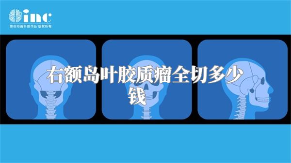 右额岛叶胶质瘤全切多少钱    