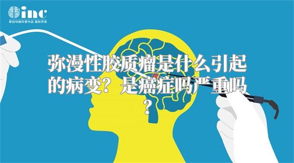 弥漫性胶质瘤是什么引起的病变？是癌症吗严重吗？