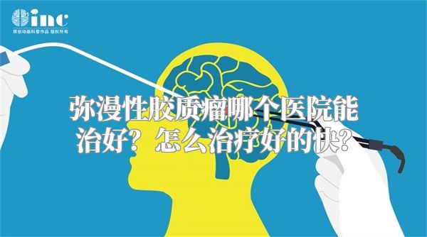 弥漫性胶质瘤哪个医院能治好？怎么治疗好的快？