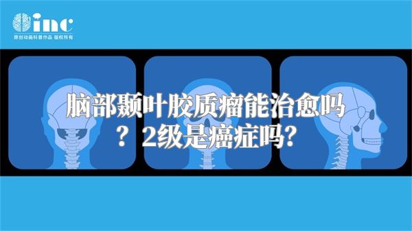 脑部颞叶胶质瘤能治愈吗？2级是癌症吗？