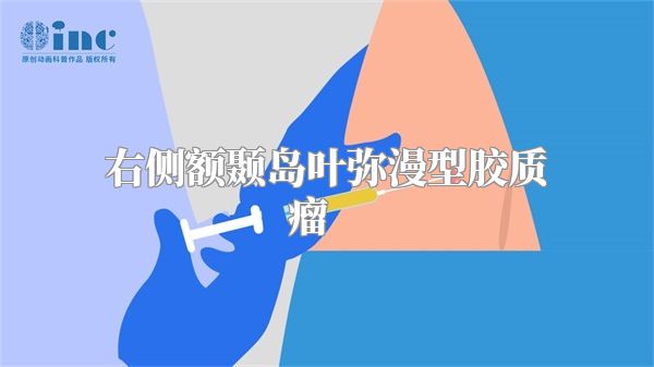 右侧额颞岛叶弥漫型胶质瘤    