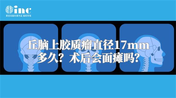 丘脑上胶质瘤直径17mm多久？术后会面瘫吗？