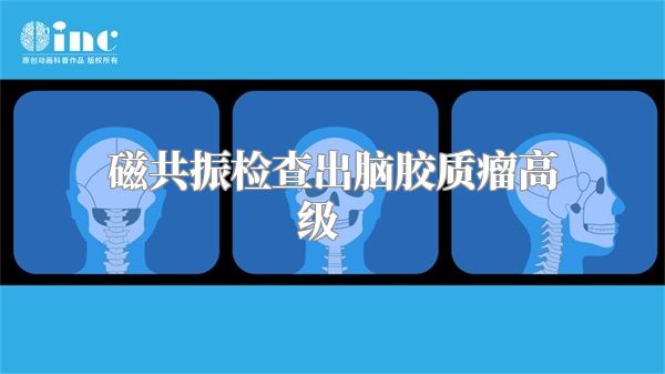 磁共振检查出脑胶质瘤高级    