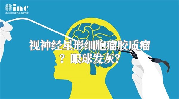 视神经星形细胞瘤胶质瘤？眼球发灰？