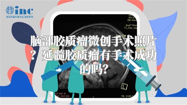 脑部胶质瘤微创手术照片？延髓胶质瘤有手术成功的吗？