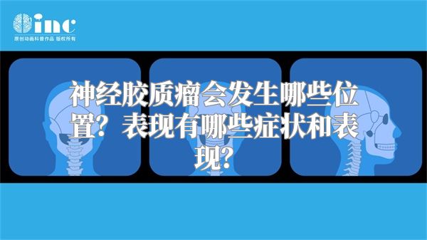 神经胶质瘤会发生哪些位置？表现有哪些症状和表现？