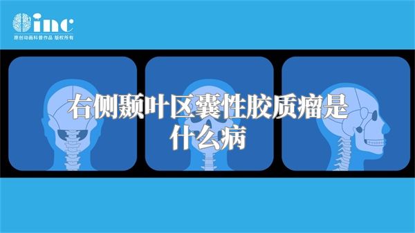 右侧颞叶区囊性胶质瘤是什么病