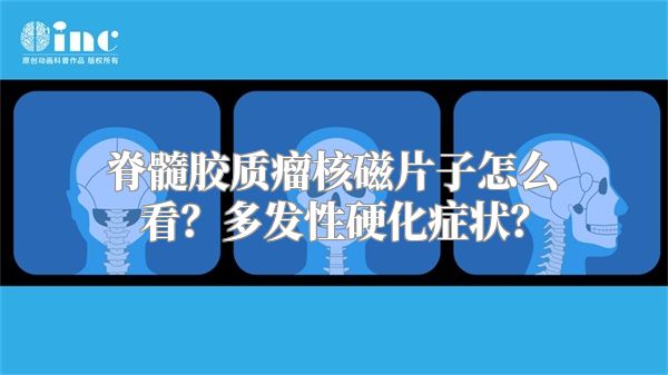 脊髓胶质瘤核磁片子怎么看？多发性硬化症状？