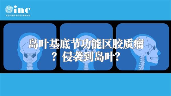 岛叶基底节功能区胶质瘤？侵袭到岛叶？