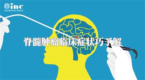 脊髓肿瘤临床症状巧了解