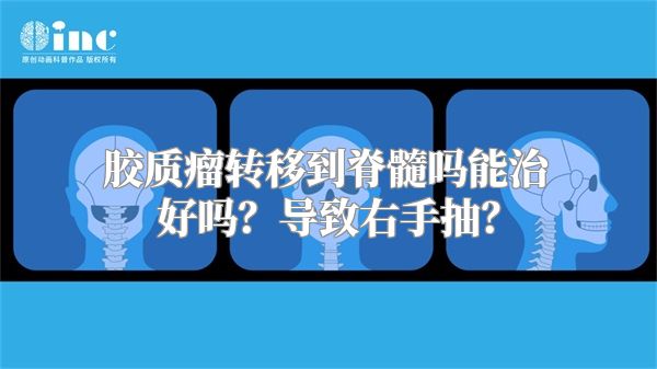 胶质瘤转移到脊髓吗能治好吗？导致右手抽？