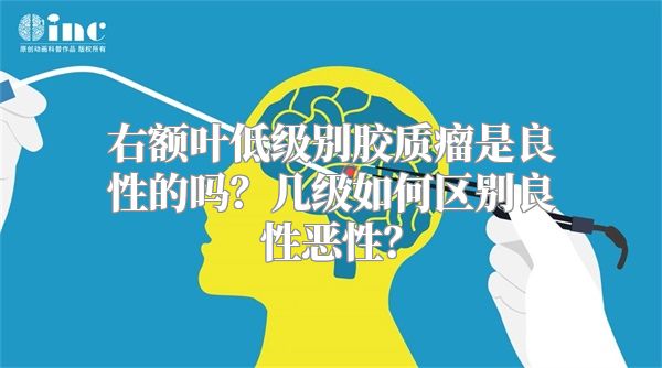 右额叶低级别胶质瘤是良性的吗？几级如何区别良性恶性？