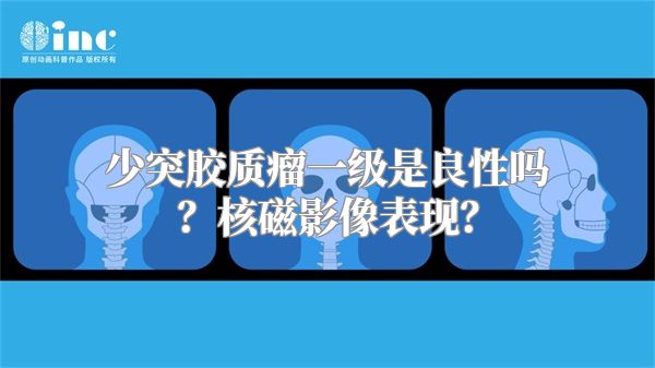 少突胶质瘤一级是良性吗？核磁影像表现？