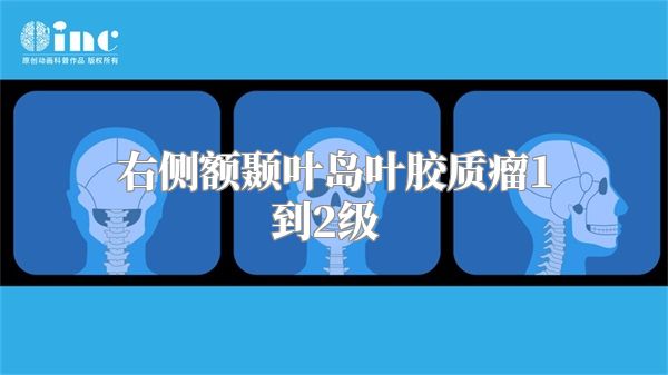 右侧额颞叶岛叶胶质瘤1到2级  