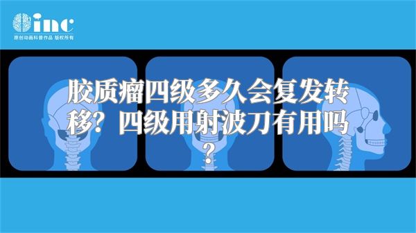 胶质瘤四级多久会复发转移？四级用射波刀有用吗？