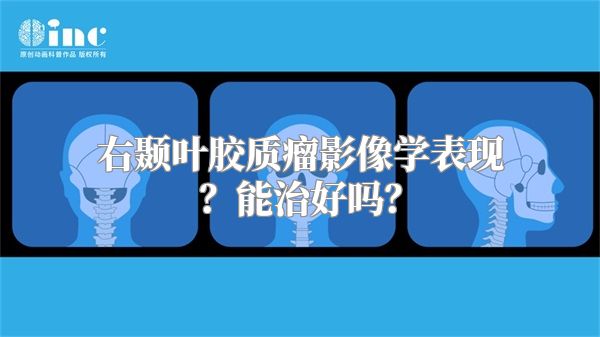 右颞叶胶质瘤影像学表现？能治好吗？