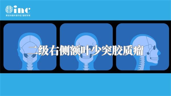 二级右侧额叶少突胶质瘤