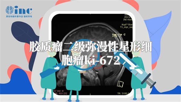 胶质瘤二级弥漫性星形细胞瘤ki-672