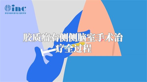 胶质瘤右侧侧脑室手术治疗全过程