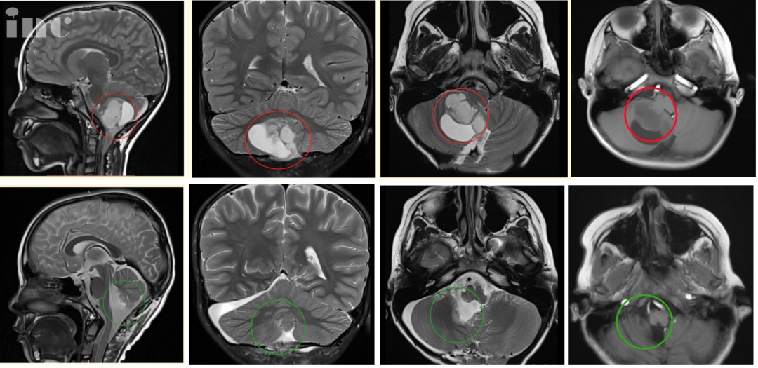 6岁男孩小脑-脑干毛细胞星形细胞瘤