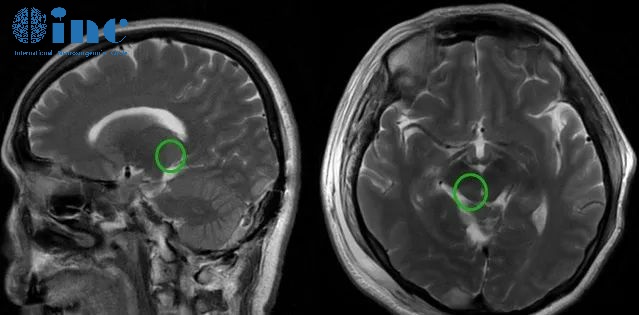 高难度丘脑胶质瘤术后患者自述——术后影像
