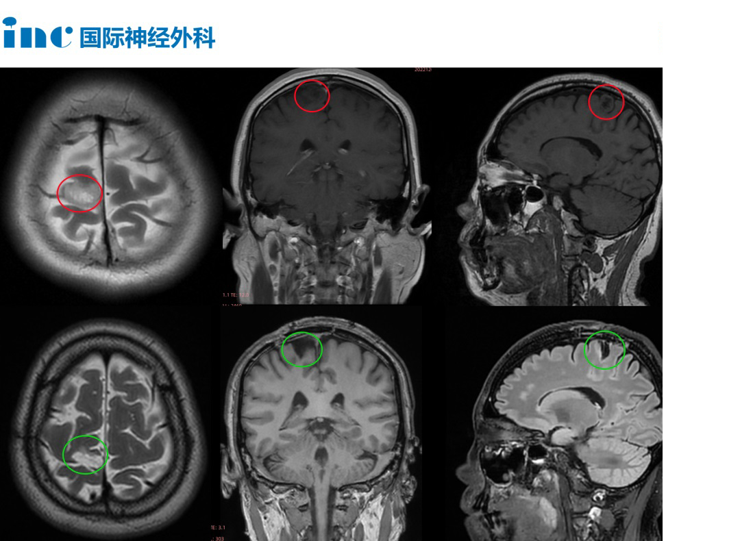 功能区胶质瘤术后1年案例