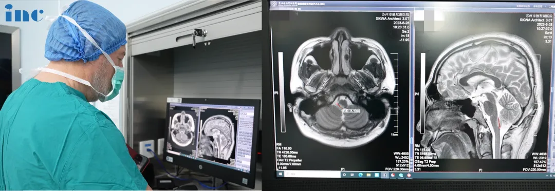 术前巴教授多次查看患者术前核磁