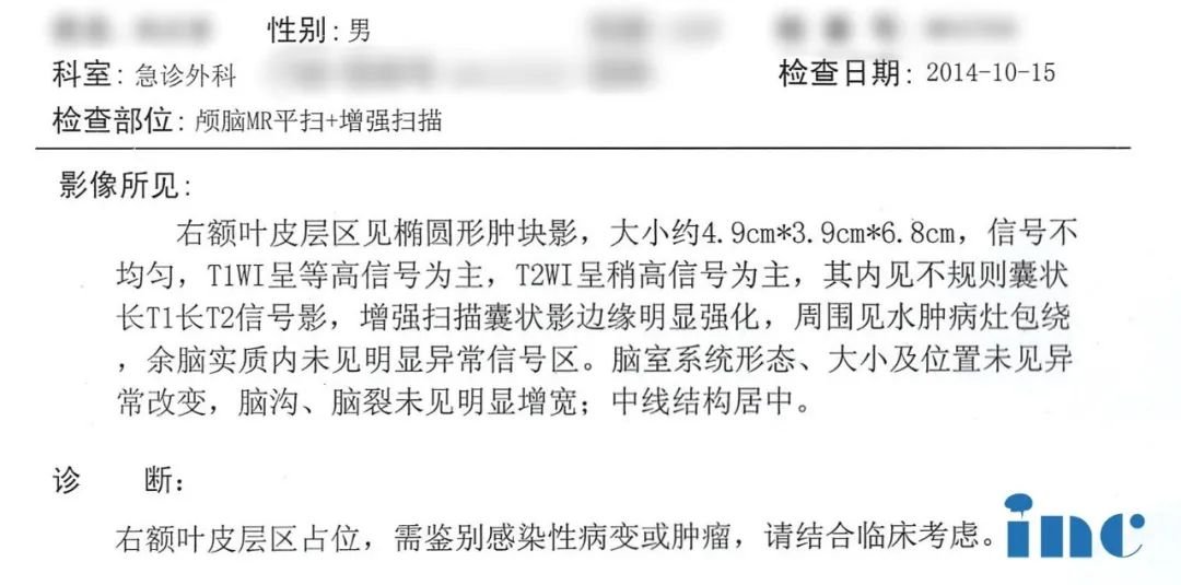 巨大胶质瘤术后3年竟可以行云流水打八段锦！