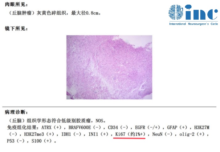 高难度丘脑胶质瘤术后患者自述——检查