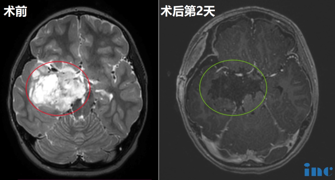 <a href='/jibing/naojiaozhiliu/1803.html' target='_blank'><u>胶质瘤手术</u></a>