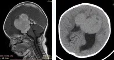 一岁小朋友较大颅脑鞍区胶质瘤案例，三名国际教授连夜提供意见