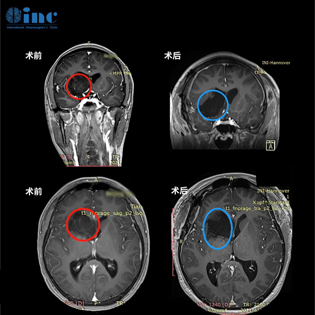 基底节胶质瘤案例图片