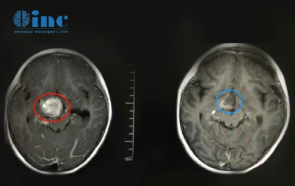 5岁患儿 视神经下丘脑胶质瘤影像
