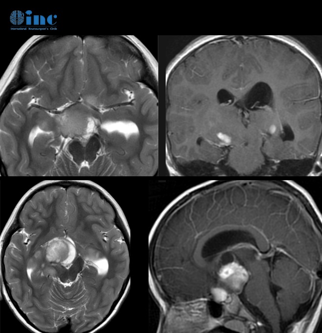 3岁患儿双侧视神经、下丘脑胶质瘤治疗记录