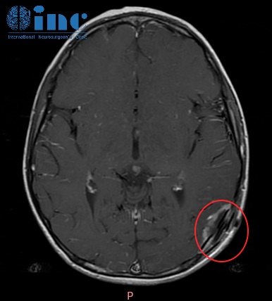 儿童胶质瘤术后影像