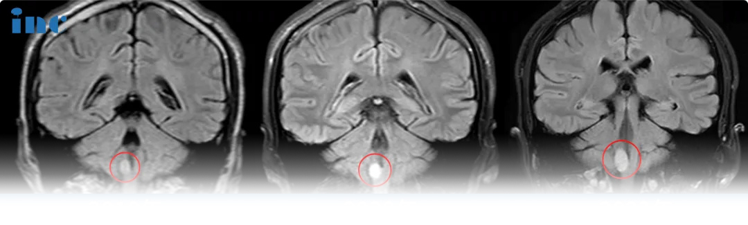 脑干延髓胶质瘤真实案例影像图片