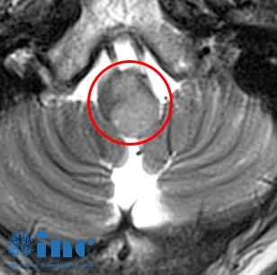 恶性脑干弥漫中线胶质瘤影像