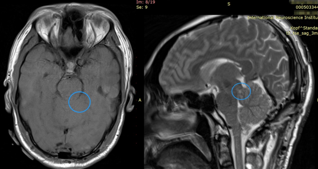 脑干-顶盖胶质瘤术后影像