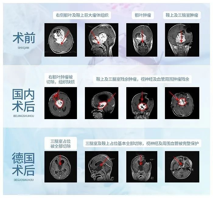 5岁视神经胶质瘤患儿