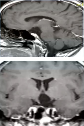 复杂视神经-下丘脑胶质瘤术后MRI