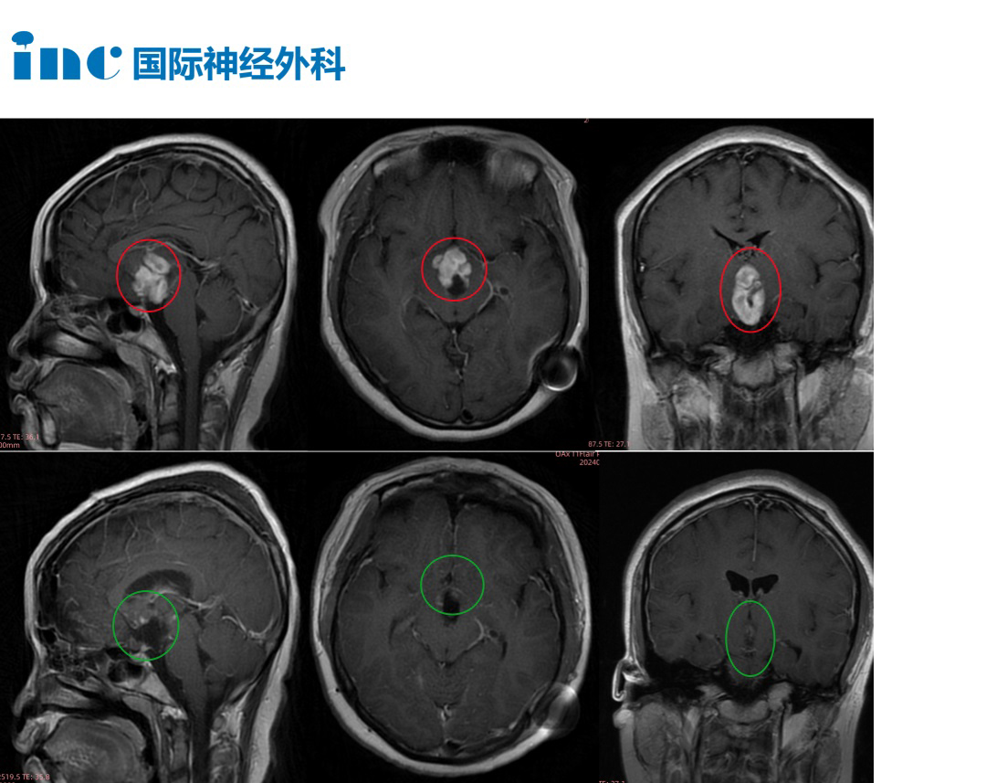 视神经-下丘脑区较大胶质瘤案例