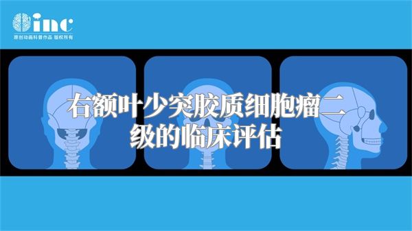 右额叶少突胶质细胞瘤二级的临床评估