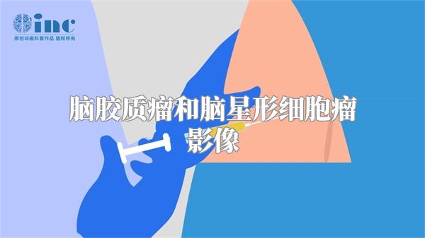 脑胶质瘤和脑星形细胞瘤影像