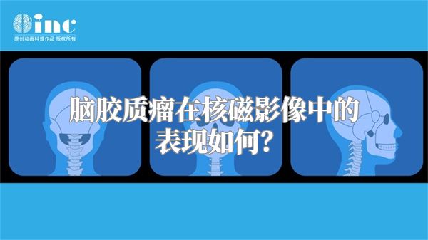 脑胶质瘤在核磁影像中的表现如何？