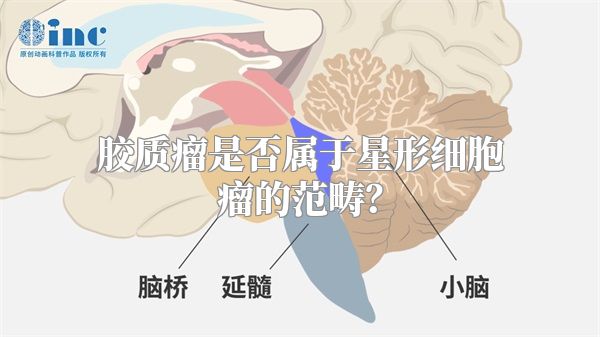 胶质瘤是否属于星形细胞瘤的范畴？