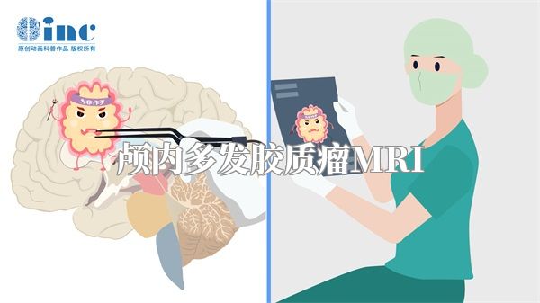 颅内多发胶质瘤MRI