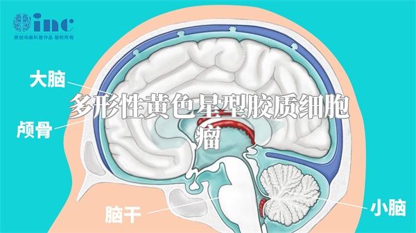 多形性黄色星型胶质细胞瘤