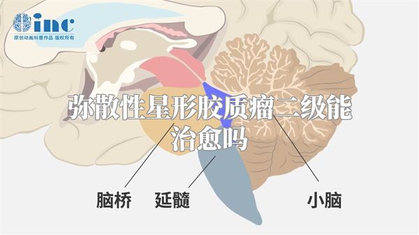 弥散性星形胶质瘤二级能治愈吗