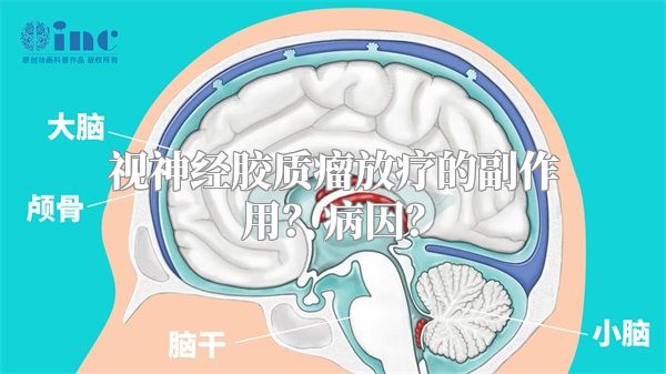 视神经胶质瘤放疗的副作用？病因？