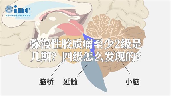 弥漫性胶质瘤至少2级是几期？四级怎么发现的？